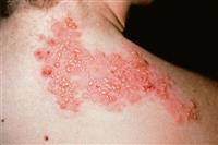 4+ Cách Chữa Bệnh Zona Theo Dân Gian | Chăm Sóc Sức Khỏe