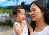 Hướng Dẫn Chi Tiết Cách Điều Trị Bệnh Tay Chân Miệng Tại Nhà