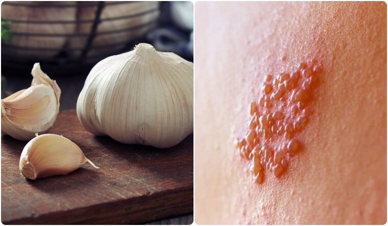 cách chữa bệnh zona theo dân gian