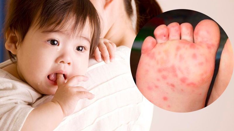 cách điều trị bệnh tay chân miệng tại nhà