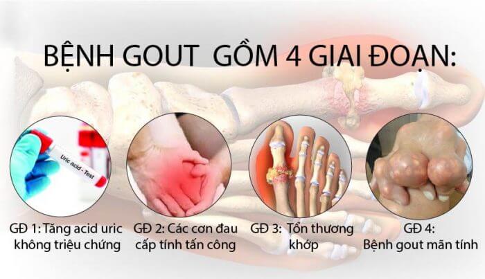 giai đoạn đầu của bênh gút