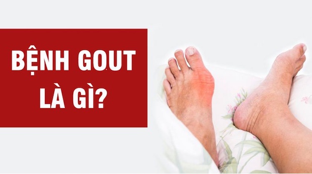 giai đoạn đầu của bênh gút