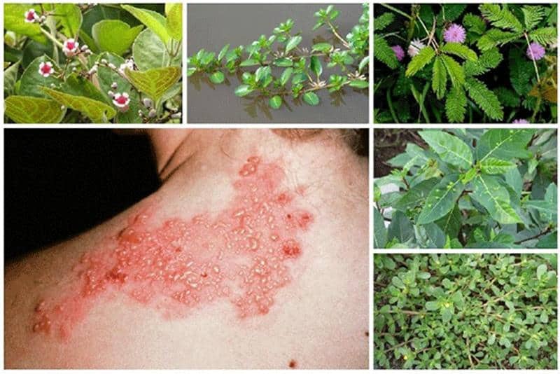 Cách chữa bệnh zona theo dân gian