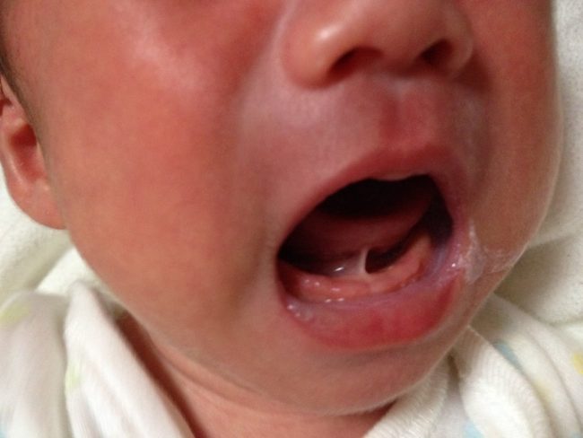 trẻ bị dính thắng lưỡi